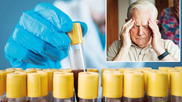 Kan testiyle Alzheimer’a erken teşhis
