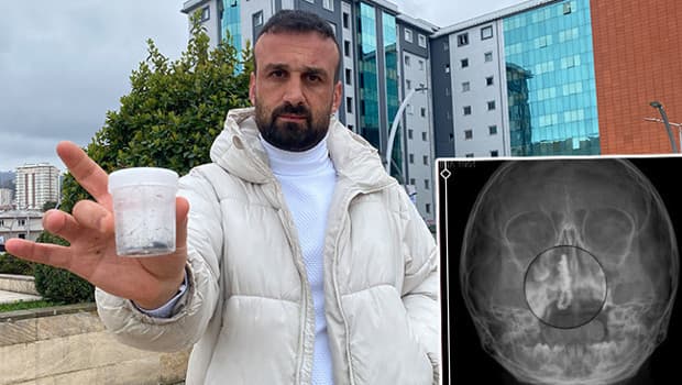Şiddetli kanama ve akıntı şikayetiyle gitti: 5 yaşındaki Polen'in 2 yıl boyunca burnundaymış! ''Bu nasıl gözden kaçılabilir?'