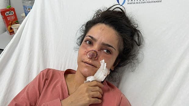 Manisa'da alkollü koca dehşeti! Eşi tarafından burnu ısırılıp koparılan İmran: Balkondan atlamayı düşündüm