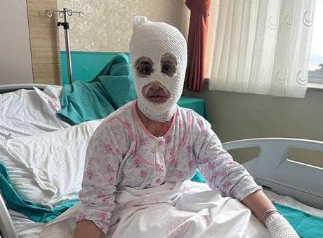 İftar vakti düdüklü tencere faciası! ‘Yüzüme elimi sürdüm, et parçası geliyordu'