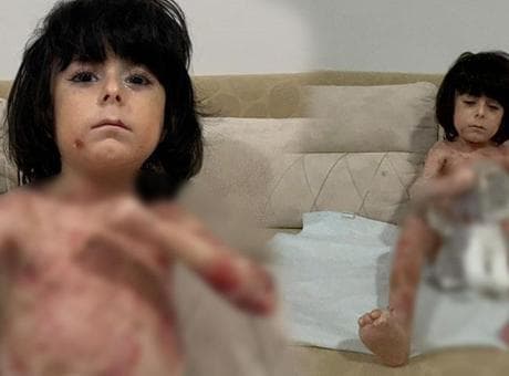 Yaraları tüm vücudunu sardı! 4 yıldır mücadele ediyor: Çaresiz durumda