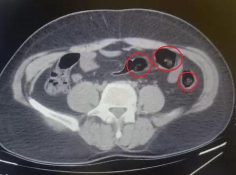 Yolcu otobüsünde şoke eden operasyon! Mide ve bağırsaklarından yarım kilo uyuşturucu çıktı