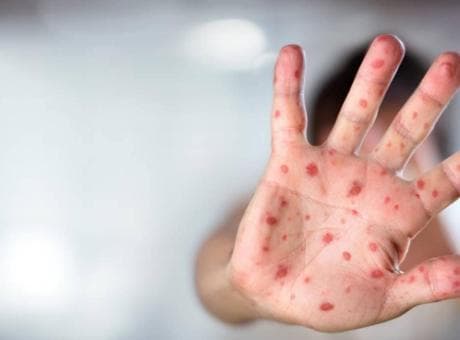 Ülkeyi kızamık kabusu sardı! 779 çocuk hayatını kaybetti