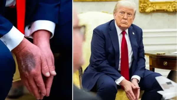 Şişlik ve morarma iddiaları sonrası Trump’ın sağlık raporu açıklandı