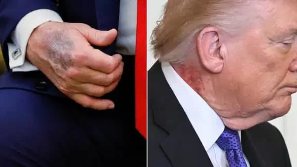Morluğun ardından kızarıklık... Trump'ın doktorundan açıklama geldi