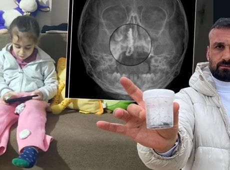 Rize’de akılalmaz olay! 5 yaşındaki Polen, 2 yıldır burnunda taşıyordu: Bu nasıl gözden kaçılabilir?